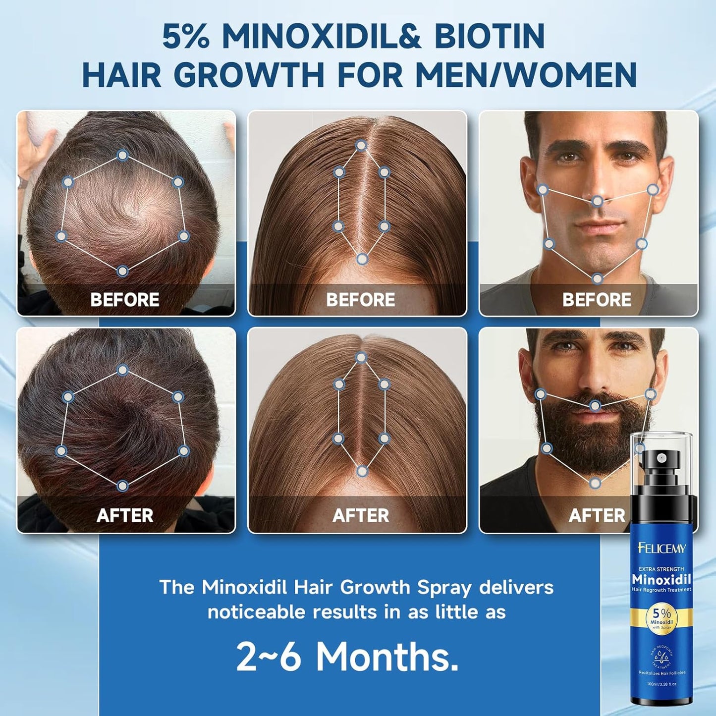 5% Minoxidil for Men and Women Hair Growth, Minoxidil Spray For Beard Growth Serum, Combat Hair Thinning and Loss, Strengthen Regrowth Treatment 3.38 Fl Oz