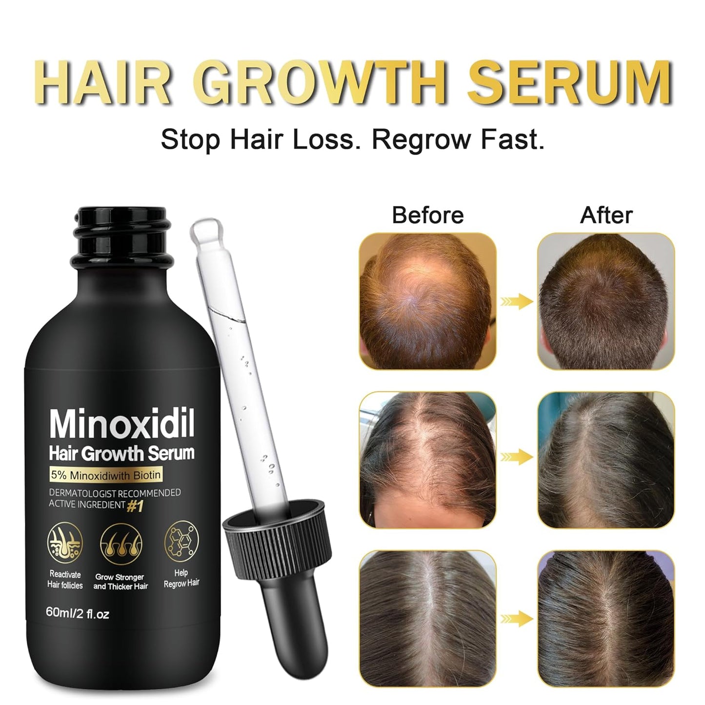 5% Minoxidil Hair Growth Serum, Topical Minoxidil for Men and Women, Hair Regrowth Treatment for Scalp Hair Loss and Thinning, With Biotin - 2.02 Fl oz