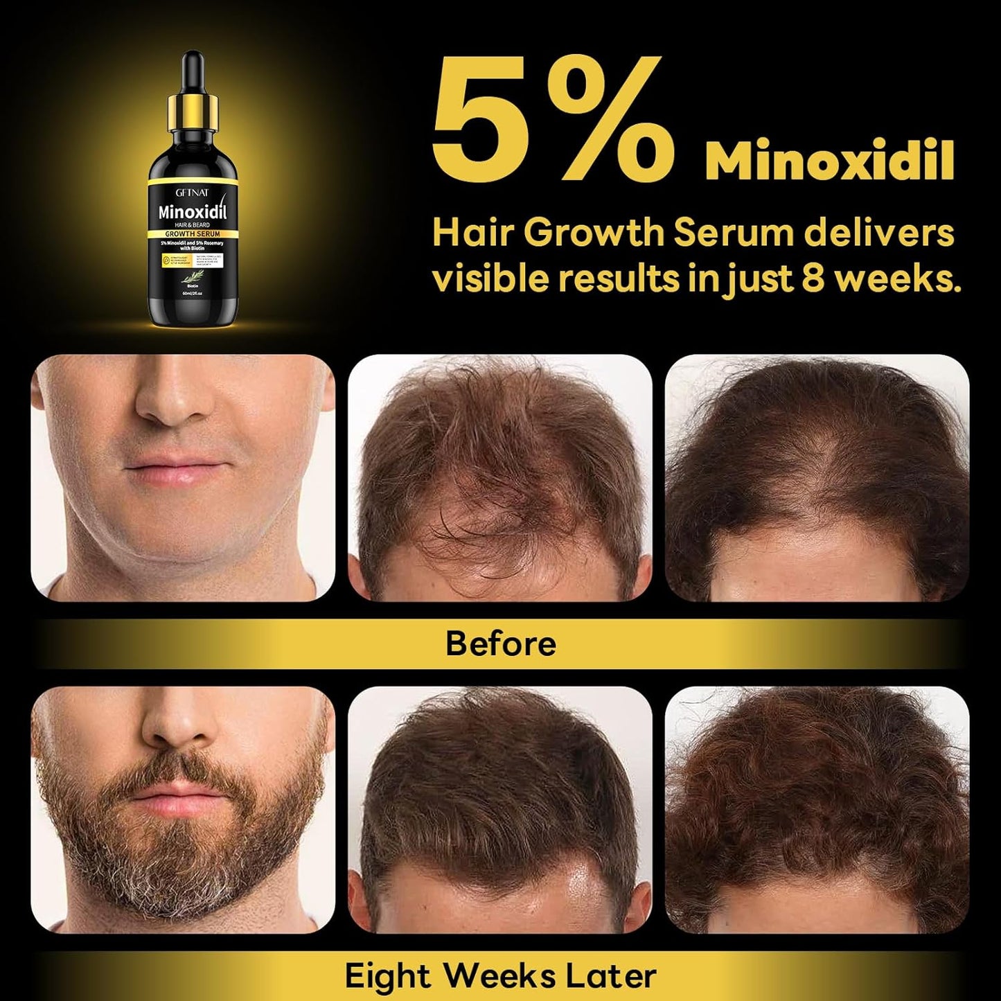 5% Minoxidil with Rosemary and Biotin for Men and Women Hair Growth,Beard Growth Kit,Scalp Serum for Thicker Fuller Hair