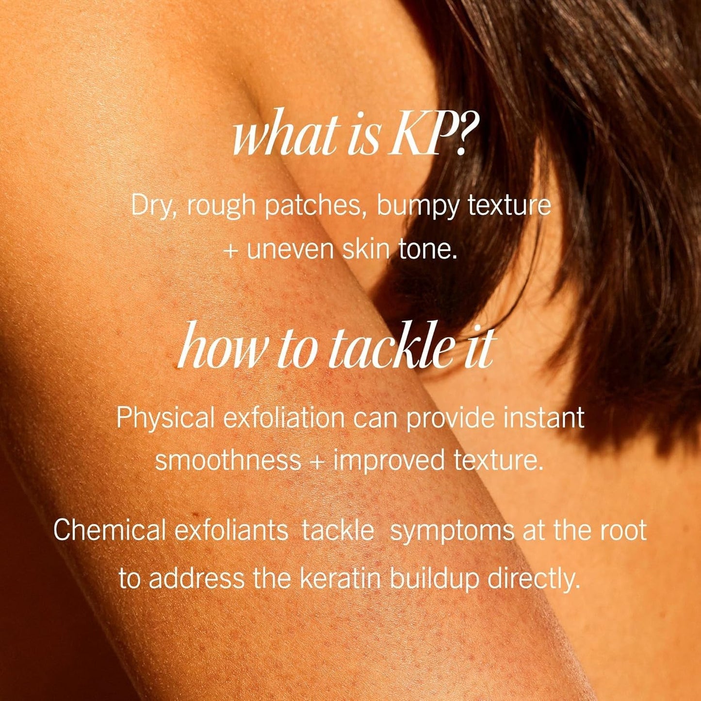 First Aid Beauty - KP Bump Eraser Body Scrub with 10% AHA, Keratosis Pilaris Skin Exfoliater with Glycolic and Lactic acids, Helps Reduce Chicken Skin Bumps, Safe for Sensitive Skin, 10 oz